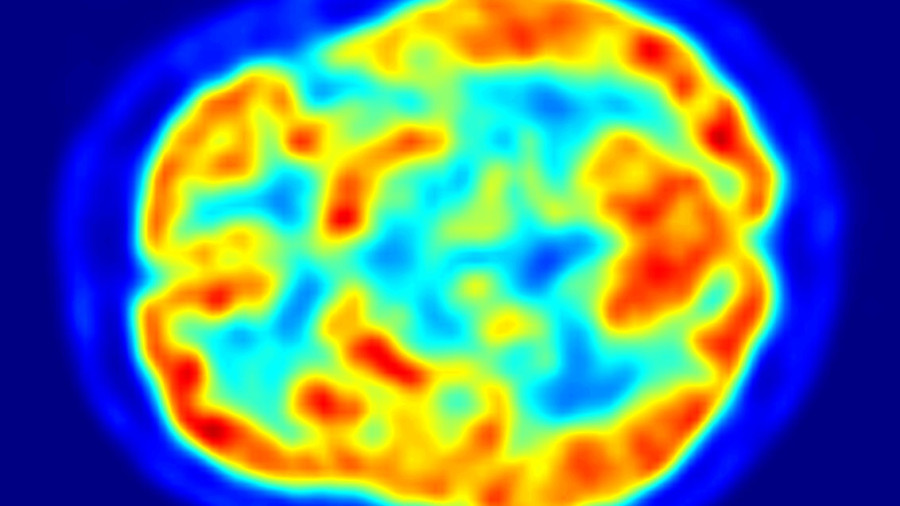 PET scan of brain